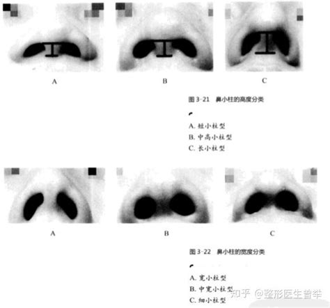 鼻孔中間叫什麼|鼻整形科普：认识鼻背、鼻尖、鼻翼、鼻小柱、鼻孔分。